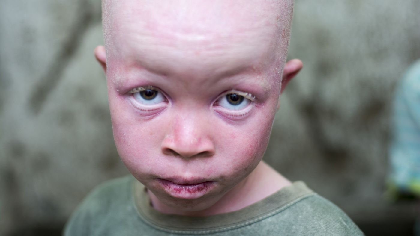 Why People Give Birth To Dwarfs Or Albinos