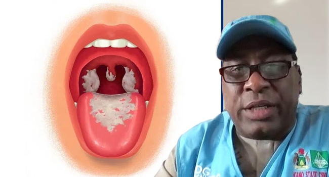 Kano Records 32,633 Confirmed Diphtheria Cases, 1,744 Deaths